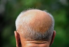 Hair Loss